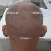 Пациент Р. Донорская область через 5 дней после пересадки волос