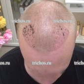 Пациент Р через 5 дней после пересадки волос