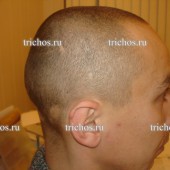 Пациент А1 через 6 месяцев.Очаговая алопеция.