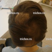 Пациент М2 (6 лет) через 3 месяца. Рост новых волос.Очаговая алопеция.