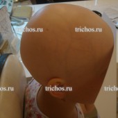 Пациент Ч3 до лечения (ребёнок 10лет).Очаговая алопеция.