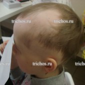 Пациент Ч3 через 7 месяцев (ребёнок 10лет). Очаговая алопеция.