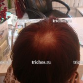 Пациент Н2 через 3 месяца. Рост новых волос. Очаговая алопеция.