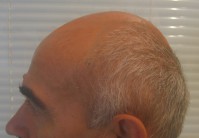 Пересадка волос у мужчин екатеринбург