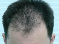 Сколько стоит пересадка волос на голове у мужчин екатеринбург