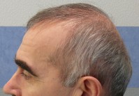 Пересадка волос у мужчин в челябинске