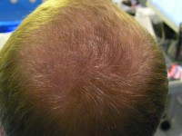 Пересадка волос у мужчин в челябинске