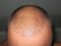 Екатеринбург пересадка волос на голове у мужчин