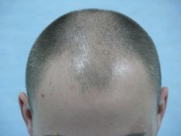 Пересадка волос у мужчин екатеринбург thumbnail