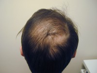 Екатеринбург пересадка волос на голове у мужчин