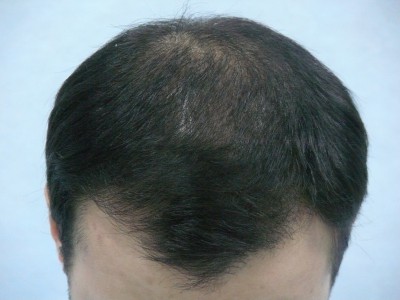 Пересадка волос у мужчин екатеринбург